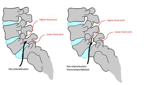 farfan torsion test on pars articularis|pars interarticularis injury statistics.